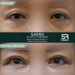Résultats avant et après chirurgie des paupières supérieures et inférieures chez SAERO