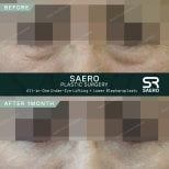 Résultats lifting sous-oculaire et blépharoplastie inférieure chez SAERO Plastic Surgery