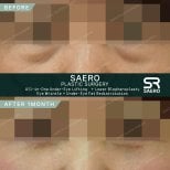 Résultats avant/après chirurgie des paupières supérieures chez SAERO Plastic Surgery, rajeunissement
