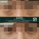 Résultats avant/après de la chirurgie des paupières supérieures chez SAERO Plastic Surgery