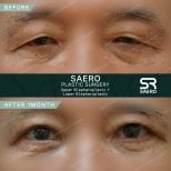 Résultats avant et après blépharoplastie supérieure et inférieure à SAERO Plastic Surgery