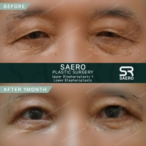 Résultats avant et après chirurgie des paupières supérieures et inférieures chez SAERO