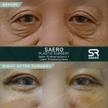 Résultats avant et après chirurgie des paupières supérieures et inférieures chez SAERO