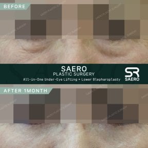 Résultats avant/après blépharoplastie inférieure et lifting chez SAERO Plastic Surgery