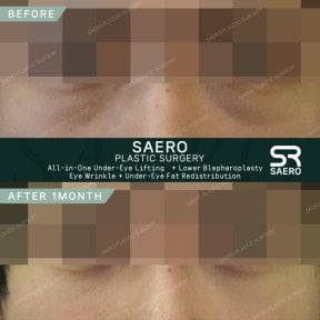 Résultats avant/après blépharoplastie inférieure chez SAERO Plastic Surgery, effet lift visible