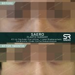 Résultats avant/après blépharoplastie inférieure chez SAERO Plastic Surgery, effet lift visible