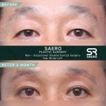 Résultats avant/après chirurgie des paupières doubles et lifting sourcil chez SAERO