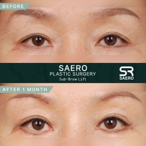 Résultats avant/après lifting sous-sourcil chez SAERO Plastic Surgery, paupières améliorées