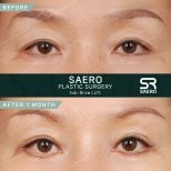 Résultats avant/après lifting sous-sourcil chez SAERO Plastic Surgery, paupières améliorées