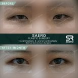 نتائج قبل وبعد رأب الجفن والكانثوبلاستي في SAERO Plastic Surgery، تصحيح الجفن
