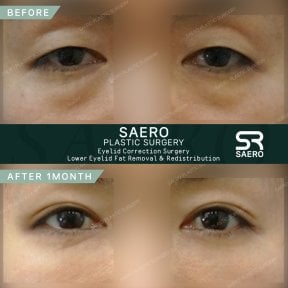 نتائج قبل وبعد تصحيح الجفن في SAERO Plastic Surgery، إزالة دهون الجفن السفلي