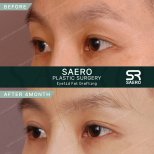 Résultats avant/après lipofilling des paupières chez SAERO Plastic Surgery, 4 mois post-op