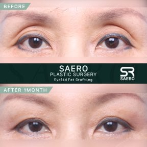 Résultats avant-après lipofilling des paupières supérieures chez SAERO Plastic Surgery, 1 mois