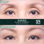 Résultats avant-après lipofilling des paupières supérieures chez SAERO Plastic Surgery, 1 mois