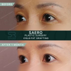 Résultats avant/après lipofilling des paupières chez SAERO Plastic Surgery, 1 mois après