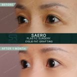 Résultats avant/après lipofilling des paupières chez SAERO Plastic Surgery, 1 mois après