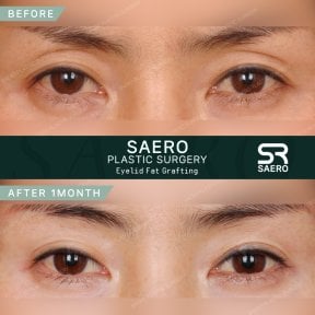 Résultats avant/après lipofilling des paupières supérieures chez SAERO Plastic Surgery, 1 mois