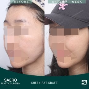 Résultats avant/après greffe de graisse des joues chez SAERO Plastic Surgery, contour amélioré