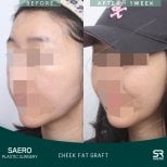 Résultats avant/après greffe de graisse des joues chez SAERO Plastic Surgery, contour amélioré