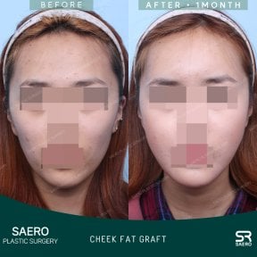 Résultats avant/après lipofilling des joues chez SAERO Plastic Surgery, joues plus pleines en 1 mois