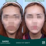 Résultats avant/après lipofilling des joues chez SAERO Plastic Surgery, joues plus pleines en 1 mois