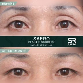 Résultats avant/après lipofilling des paupières supérieures chez SAERO Plastic Surgery, 1 mois