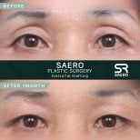 Résultats avant/après lipofilling des paupières supérieures chez SAERO Plastic Surgery, 1 mois
