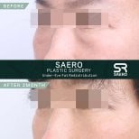 نتائج نقل الدهون تحت العين قبل وبعد في SAERO Plastic Surgery بعد شهرين
