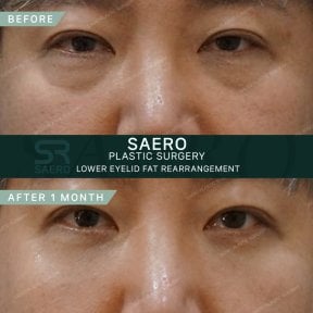 نتائج إعادة ترتيب دهون الجفن السفلي قبل وبعد في SAERO Plastic Surgery بعد شهر واحد