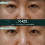 نتائج إعادة ترتيب دهون الجفن السفلي قبل وبعد في SAERO Plastic Surgery بعد شهر واحد