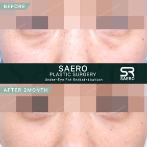 نتائج نقل الدهون تحت العين قبل وبعد في SAERO Plastic Surgery بعد شهرين