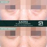 نتائج نقل الدهون تحت العين قبل وبعد في SAERO Plastic Surgery بعد شهرين