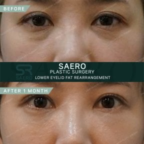 نتائج قبل وبعد إعادة توزيع دهون الجفن السفلي في عيادة SAERO لجراحة التجميل