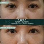 نتائج قبل وبعد إعادة توزيع دهون الجفن السفلي في عيادة SAERO لجراحة التجميل