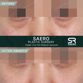 نتائج نقل الدهون تحت العين قبل وبعد في SAERO Plastic Surgery بعد شهرين