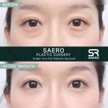 نتائج نقل الدهون تحت العين قبل وبعد في SAERO Plastic Surgery بعد شهر واحد