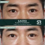 نتائج نقل الدهون تحت العين قبل وبعد في SAERO Plastic Surgery بعد شهر واحد