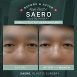 نتائج قبل وبعد إعادة توزيع دهون الجفن السفلي في عيادة SAERO للجراحة التجميلية