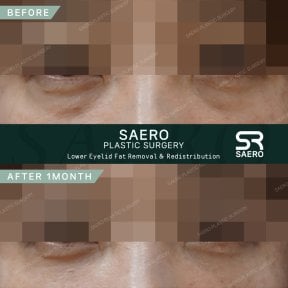 نتائج إزالة دهون الجفن السفلي بعد شهر في SAERO Plastic Surgery