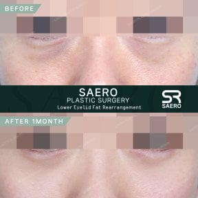 نتائج نقل دهون الجفن السفلي قبل وبعد في SAERO Plastic Surgery بعد شهر واحد