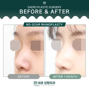 نتائج تجميل الأنف بدون ندوب قبل وبعد في SAERO Plastic Surgery، تحسين شكل الأنف