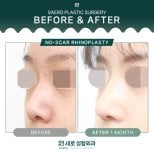 نتائج تجميل الأنف بدون ندوب قبل وبعد في SAERO Plastic Surgery، تحسين شكل الأنف