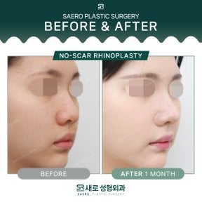 نتائج تجميل الأنف بدون ندوب في SAERO Plastic Surgery، تحسين شكل الأنف