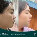 نتائج تجميل الأنف بدون ندوب في SAERO Plastic Surgery بعد أسبوعين من الجراحة