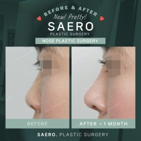 نتائج تجميل الأنف قبل وبعد في SAERO Plastic Surgery – تحسين شكل الأنف الجانبي