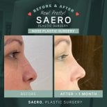 نتائج تجميل الأنف قبل وبعد في SAERO Plastic Surgery، إعادة تشكيل الأنف بعد شهر