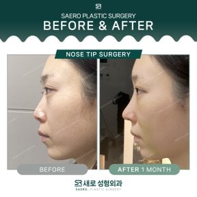 نتائج قبل وبعد جراحة طرف الأنف في SAERO Plastic Surgery، تحسين شكل الأنف