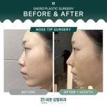 نتائج قبل وبعد جراحة طرف الأنف في SAERO Plastic Surgery، تحسين شكل الأنف