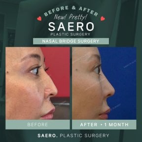 نتائج قبل وبعد جراحة جسر الأنف في SAERO Plastic Surgery، تحسين شكل الأنف