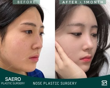 نتائج تجميل الأنف قبل وبعد في SAERO Plastic Surgery، شكل أنف محسّن بعد شهر